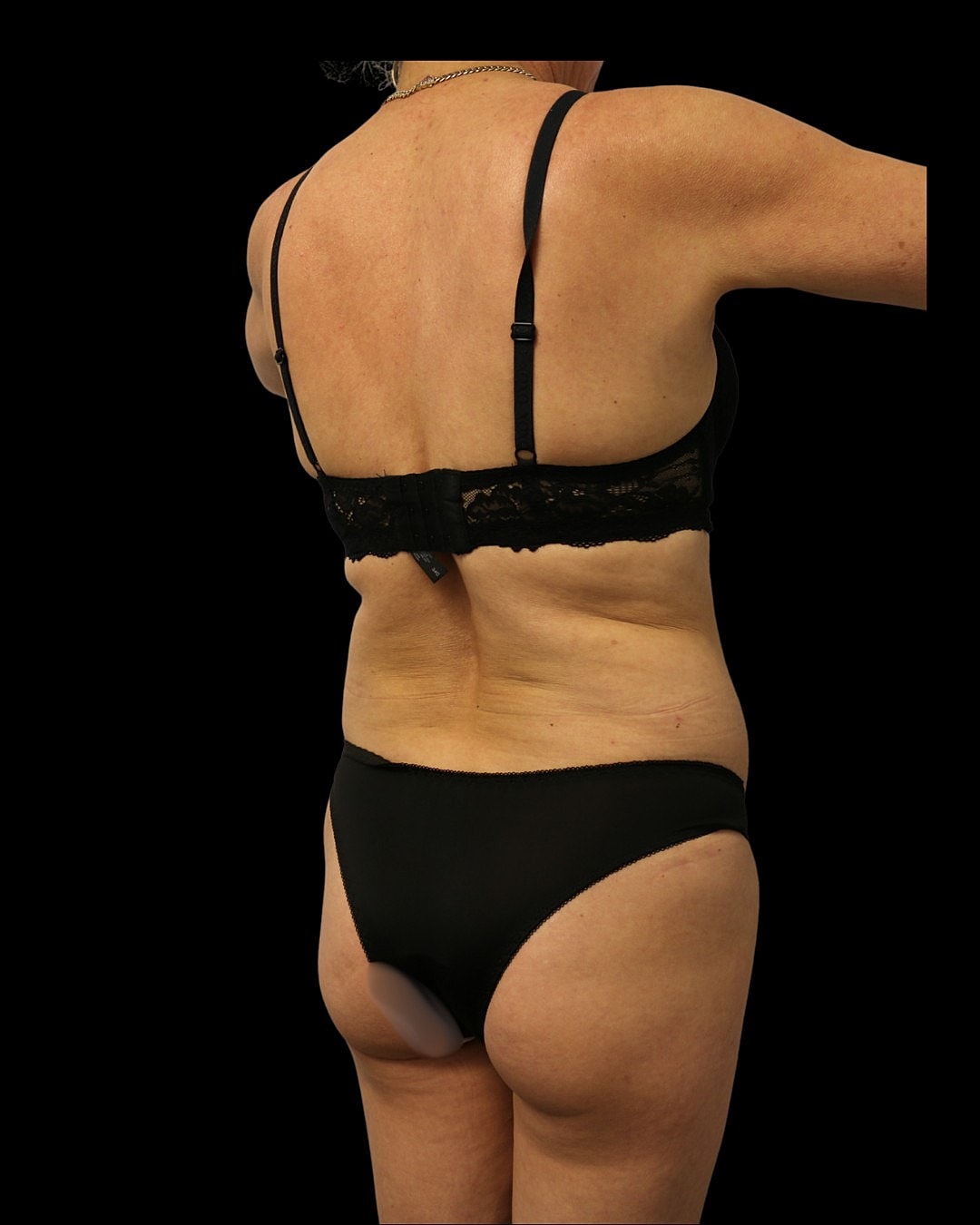 Brazilian Butt Lift Before & After
