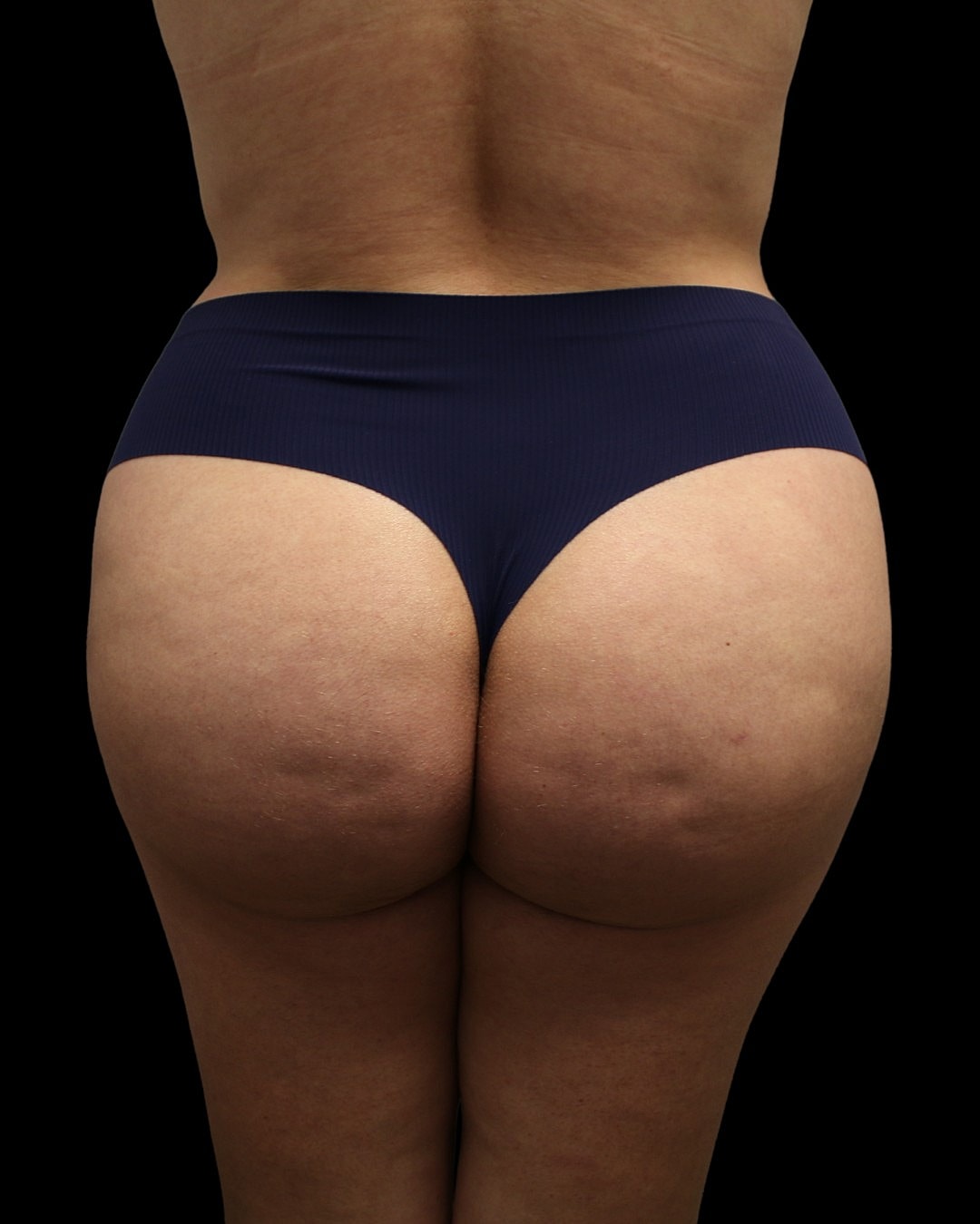 Brazilian Butt Lift Before & After