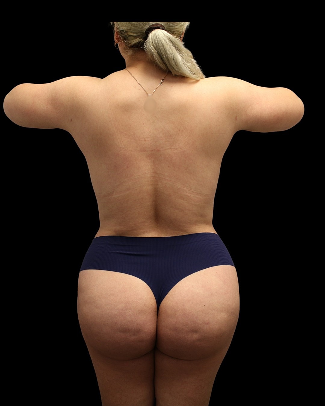 Brazilian Butt Lift Before & After