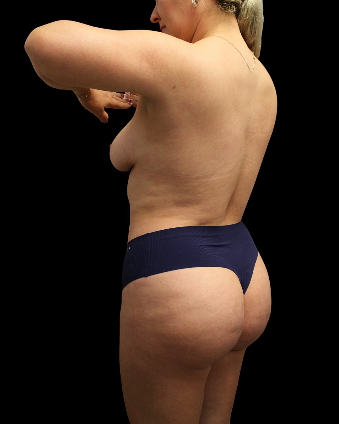 Brazilian Butt Lift Before & After