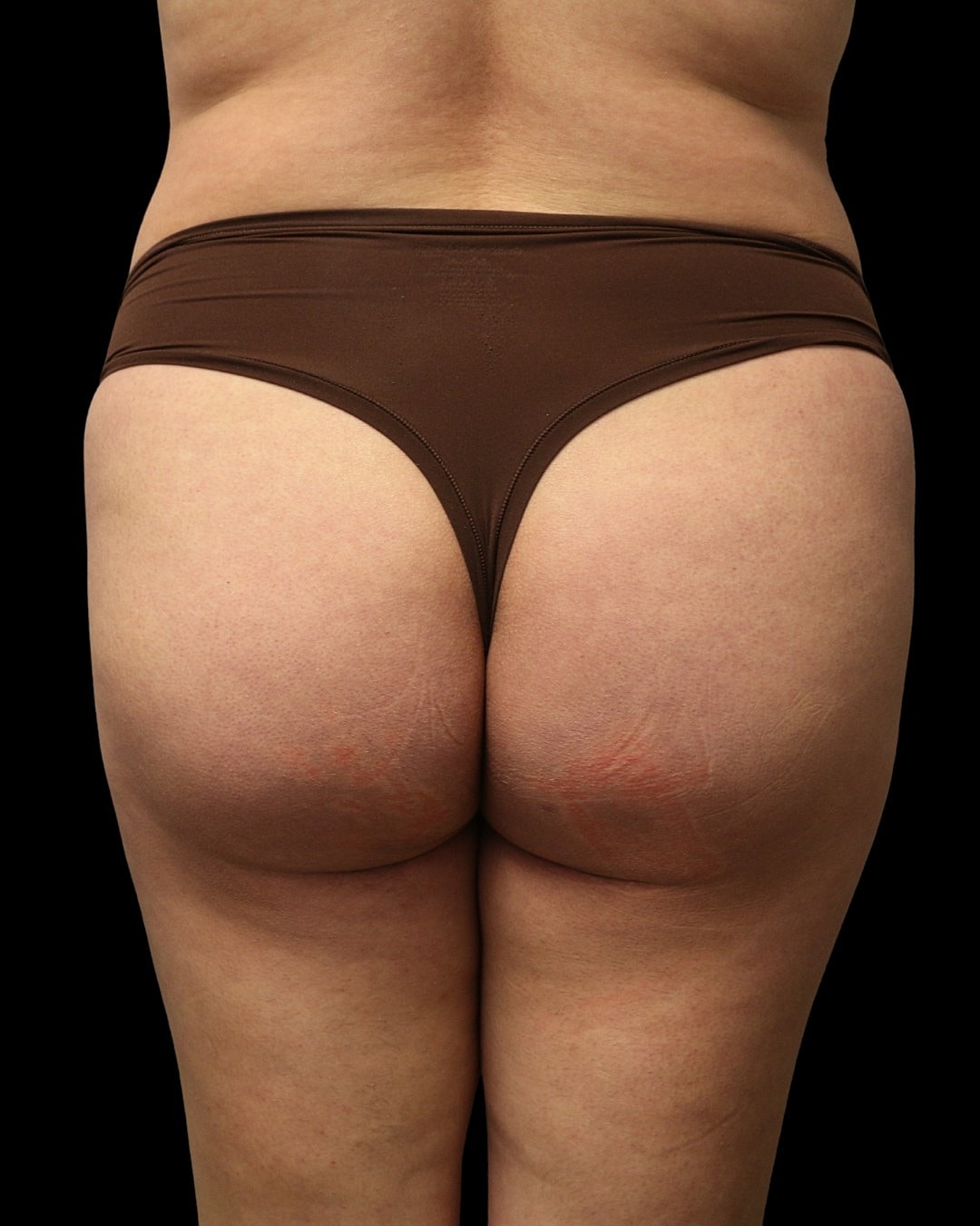 Brazilian Butt Lift Before & After