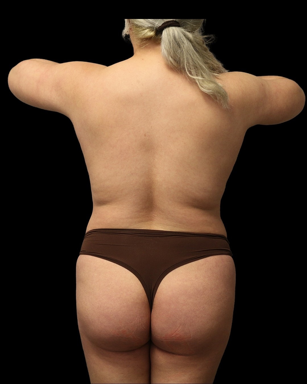 Brazilian Butt Lift Before & After