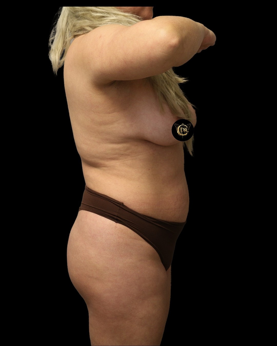 Brazilian Butt Lift Before & After