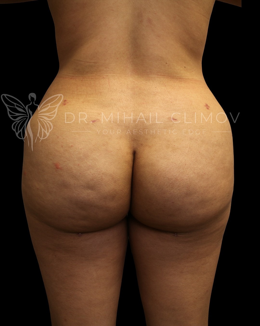 Brazilian Butt Lift Before & After