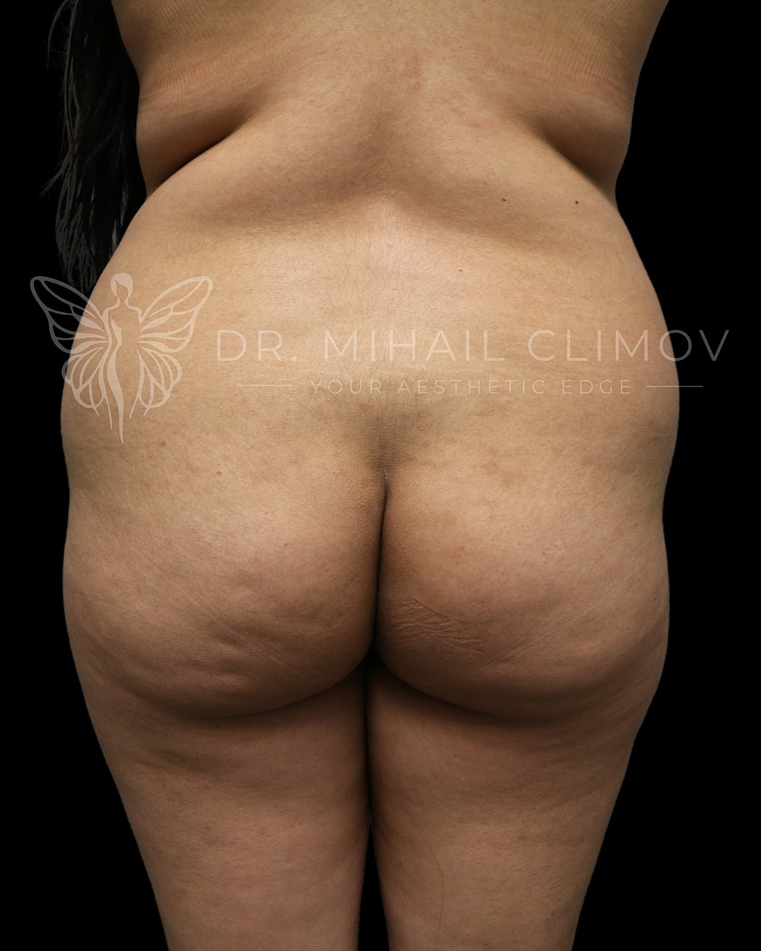 Brazilian Butt Lift Before & After