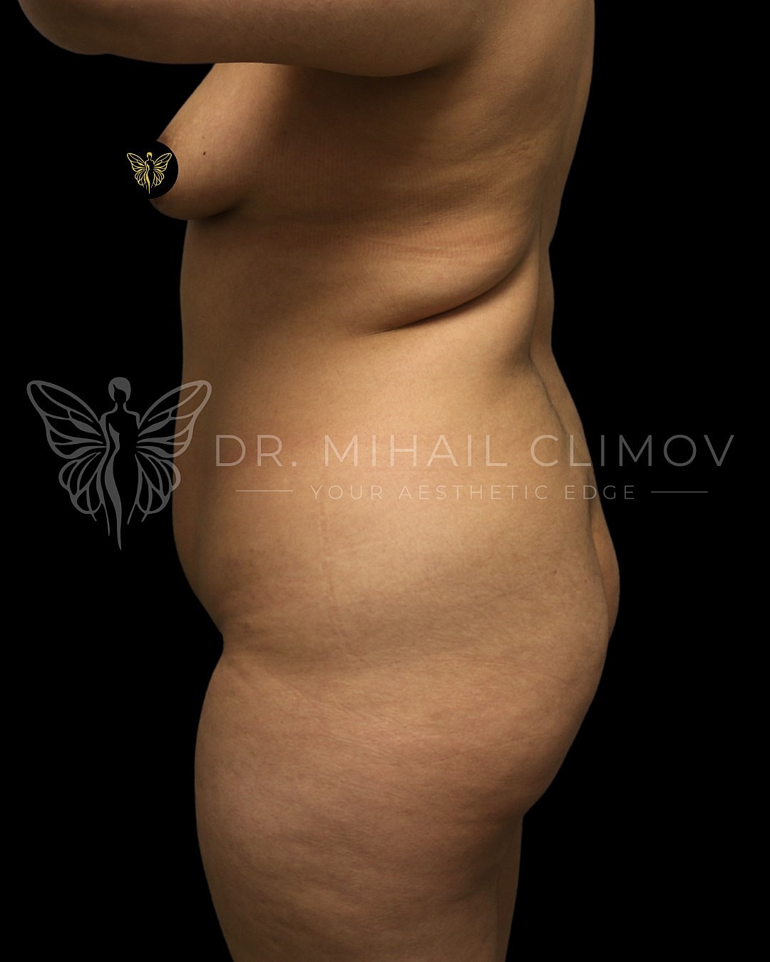 Brazilian Butt Lift Before & After