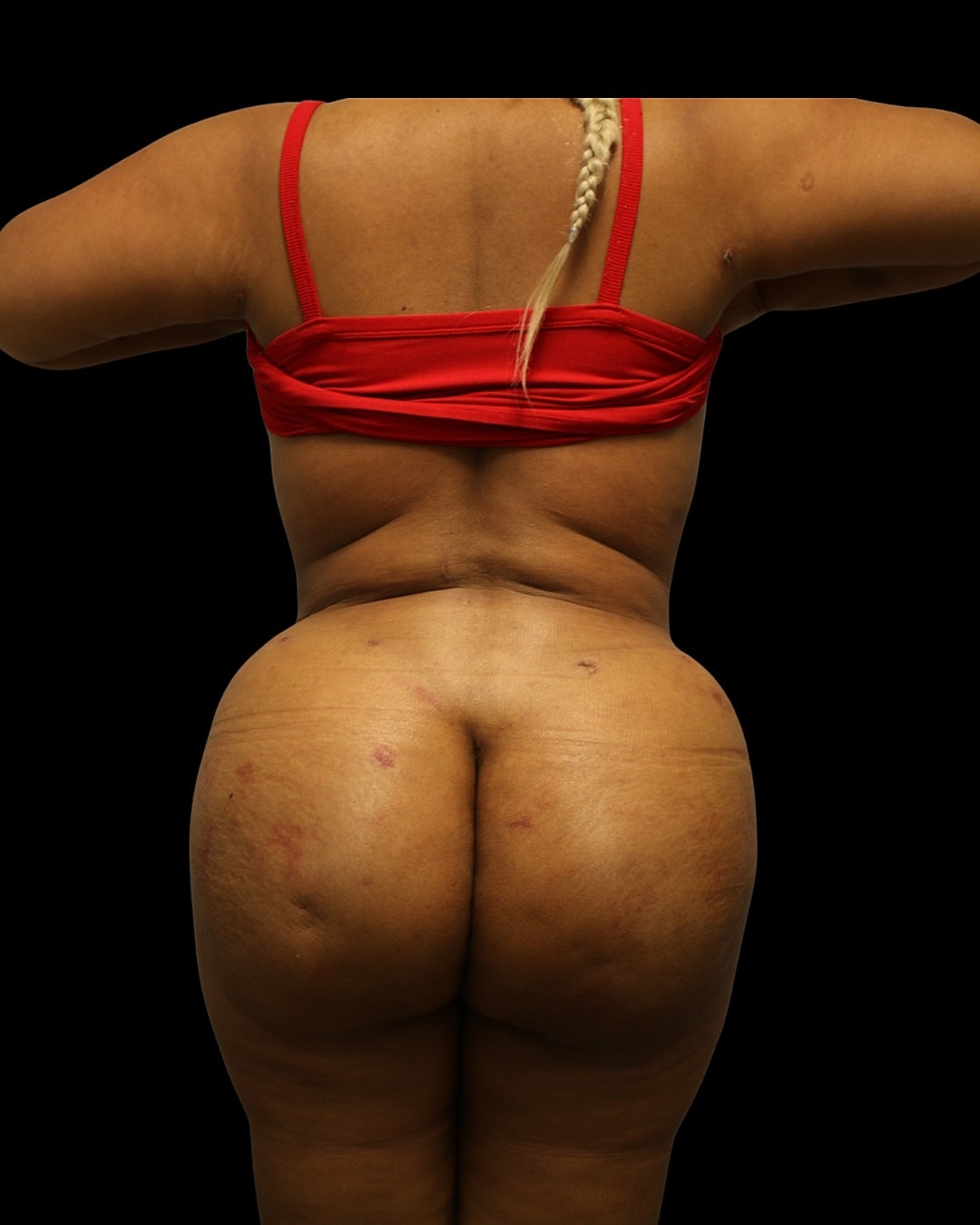 Brazilian Butt Lift Before & After