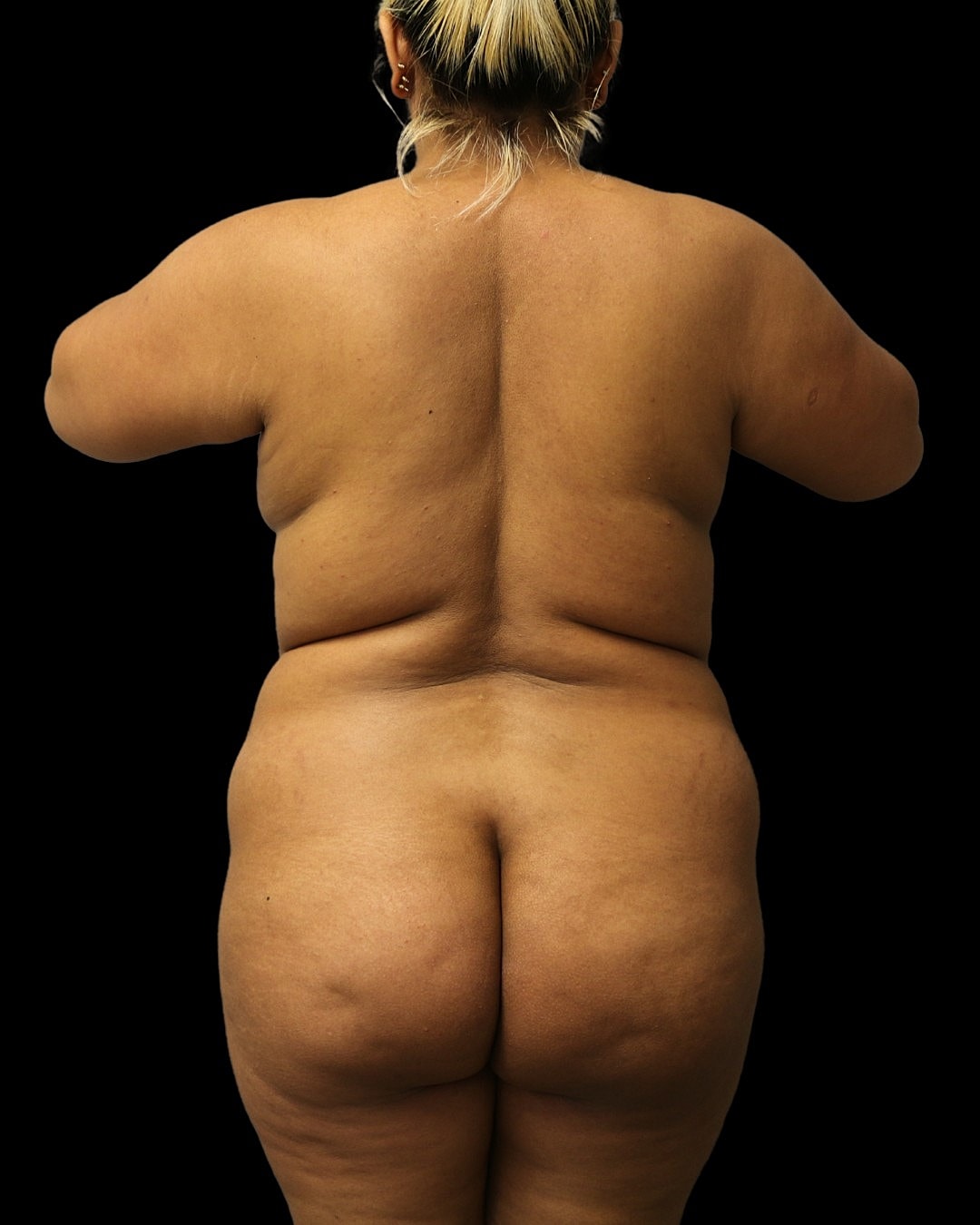 Brazilian Butt Lift Before & After