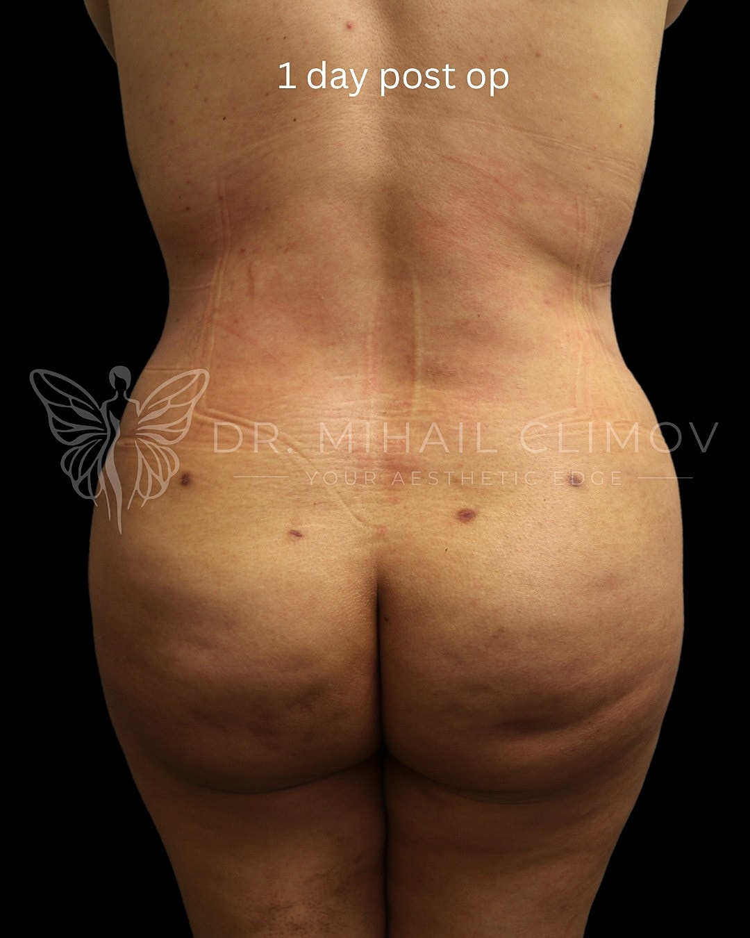 Post-operative back view, one day healing.