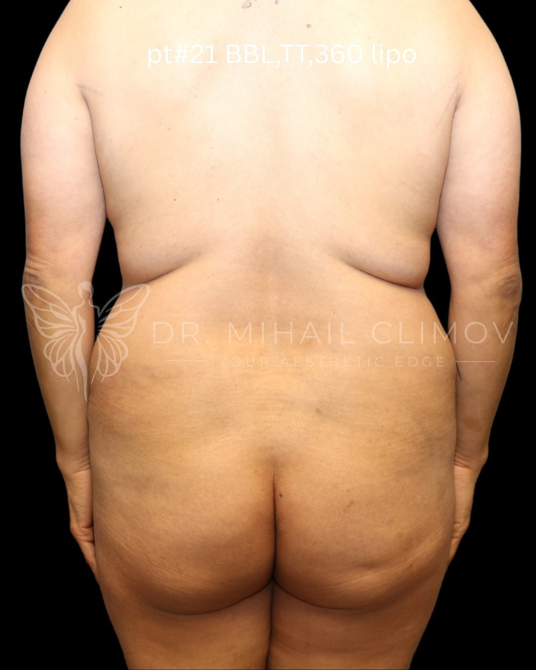 Post-surgical body transformation before and after.