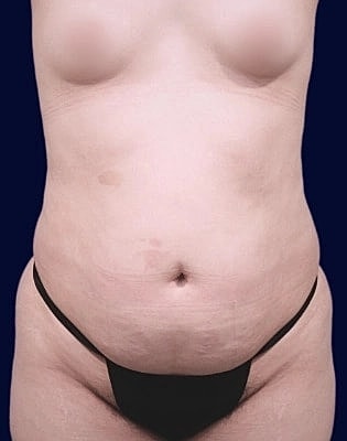 Abdominoplasty Before & After