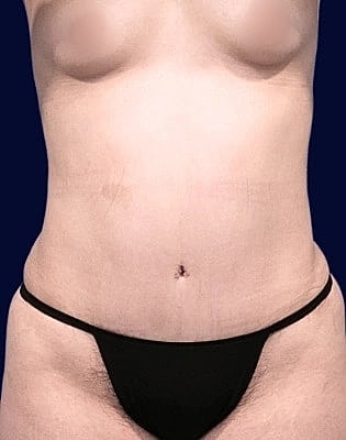 Abdominoplasty Before & After