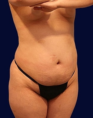 Abdominoplasty Before & After