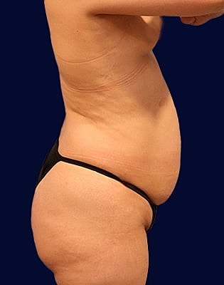 Abdominoplasty Before & After
