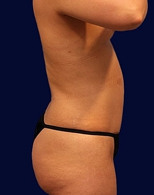 Abdominoplasty Before & After