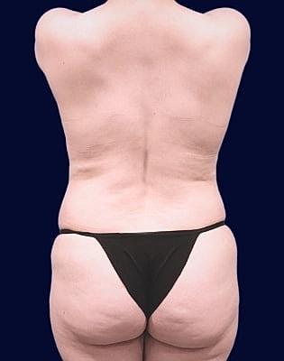 Abdominoplasty Before & After