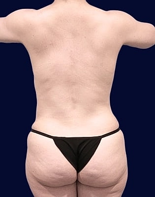 Abdominoplasty Before & After