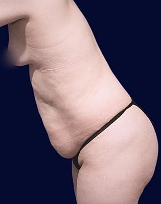 Abdominoplasty Before & After