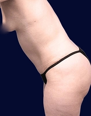 Abdominoplasty Before & After