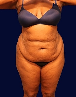 Abdominoplasty Before & After