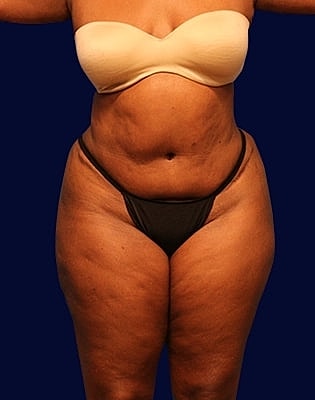 Abdominoplasty Before & After