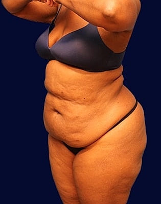 Abdominoplasty Before & After