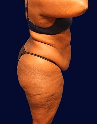 Abdominoplasty Before & After