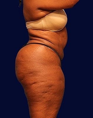 Abdominoplasty Before & After