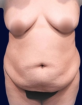 Abdominoplasty Before & After
