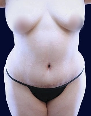 Abdominoplasty Before & After