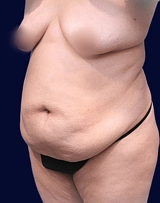 Abdominoplasty Before & After