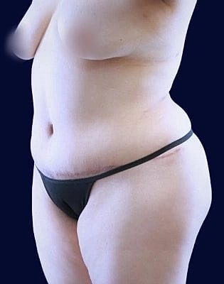 Abdominoplasty Before & After