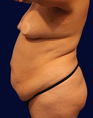 Abdominoplasty Before & After