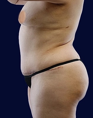 Abdominoplasty Before & After