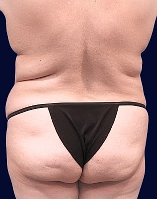 Abdominoplasty Before & After