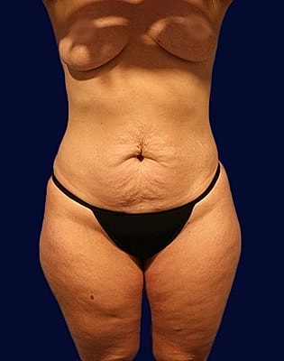 Abdominoplasty Before & After