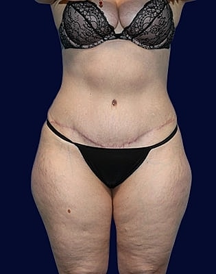 Abdominoplasty Before & After