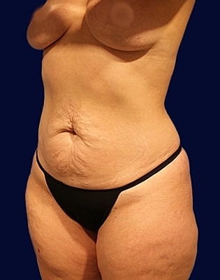 Abdominoplasty Before & After