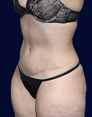 Abdominoplasty Before & After