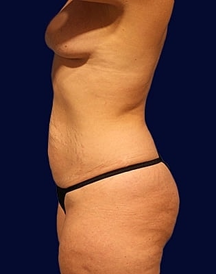 Abdominoplasty Before & After