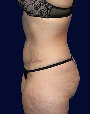 Abdominoplasty Before & After