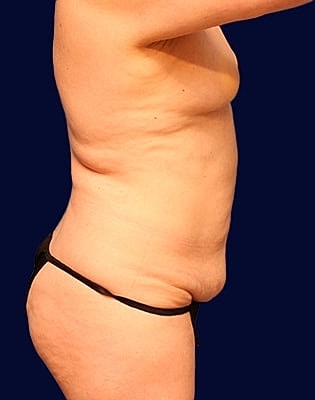 Abdominoplasty Before & After