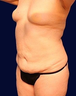 Abdominoplasty Before & After