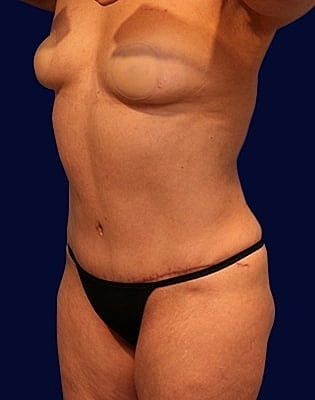 Abdominoplasty Before & After