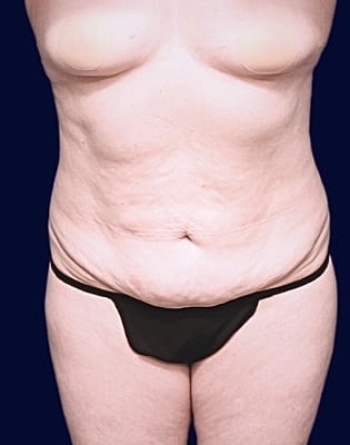 Abdominoplasty Before & After