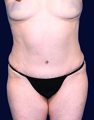 Abdominoplasty Before & After
