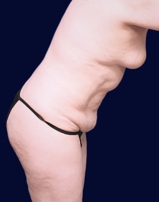 Abdominoplasty Before & After