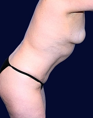 Abdominoplasty Before & After