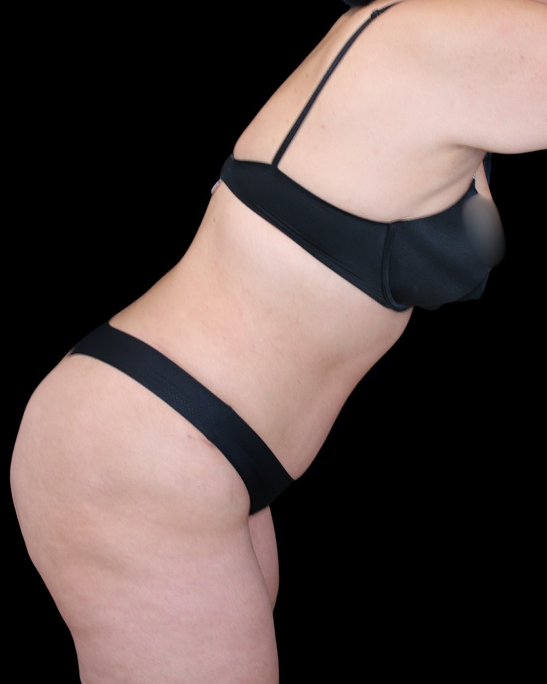 Dr. Mihail Climov tummy tuck before and after