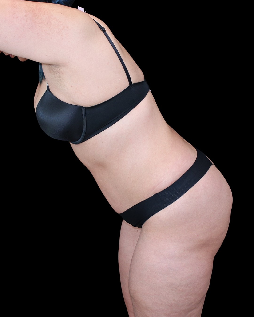 Houston plastic surgeon tummy tuck results